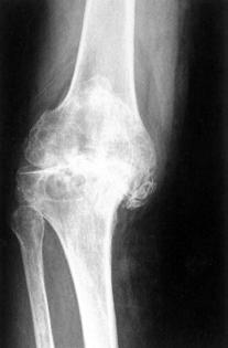 Knäledsartros Ett knä med artrosförändringar kan ge en smärtsam och mycket ansträngande gång. Artros eller artrit i knät angriper broskytan i leden.
