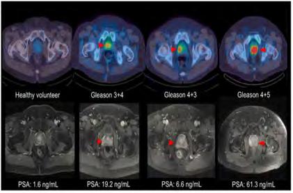 utveckling PSMA upptag associerat med Gleason Prostatic