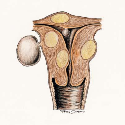ILLUSTRATION: PETER GRAHN nor som önskar bevara sin fertilitet, om enda kvarvarande behandlingsalternativ varit extensiv myomektomi eller hysterektomi [24].
