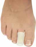 FOTBESVÄR Prisvärda kvalitetsprodukter för fötter! HALLUX VALGUS Vid hallux valgus vrider sig stortån innåt mot de andra tårna och en knöl bildas på stortåleden.