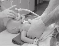 1 PRIMÄRT OMHÄNDERTAGANDE OCH NEONATAL HLR Figur 5a Figur 5b Thoraxkompressioner genomförs med endera av två tekniker: - Bäst effekt uppnås om utföraren fattar med båda händerna om barnets bröstkorg