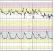 - Komplicerade variabla decelerationer (Figur 5b). Figur 4 Figur 5a Figur 5b Värkarna registreras oftast med en yttre tryckgivare placerad mot bukväggen över uterus.