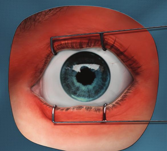 The ophthalmic news and education network. American Academy of Ophthalmology. http://one.aao.org/focalpointssnippetdetail.aspx?id=f759cd36-2047-4608-a78c-9bbd42fa7cac. Senaste åtkomst 14 juli 2016.