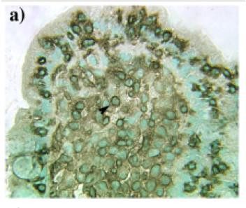 proinflammatoriska/anti-bakteriella cytokinet IL-17A aktiv CD, jejunum färgad för IFN-g aktiv CD, jejunum färgad för IL-17A Det sker en