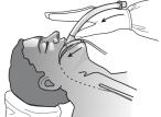När tummen närmar sig munnen sträcker sig fingrarna framåt över patientens ansikte (Fig.9). Fortsätt trycka in tummen tills den når sin fulla utsträckning (Fig.10).