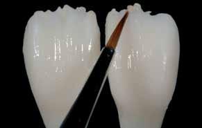 Inpassade och delreducerade IPS e.max CAD restaurationer.