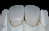 max Ceram Incisal och Opal massor.