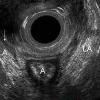 Diagnostiken försvåras av att förlossningskanalen blöder och är svullen och öm. Det saknas reproducerbara metoder för att hitta och kategorisera förlossningsskador.