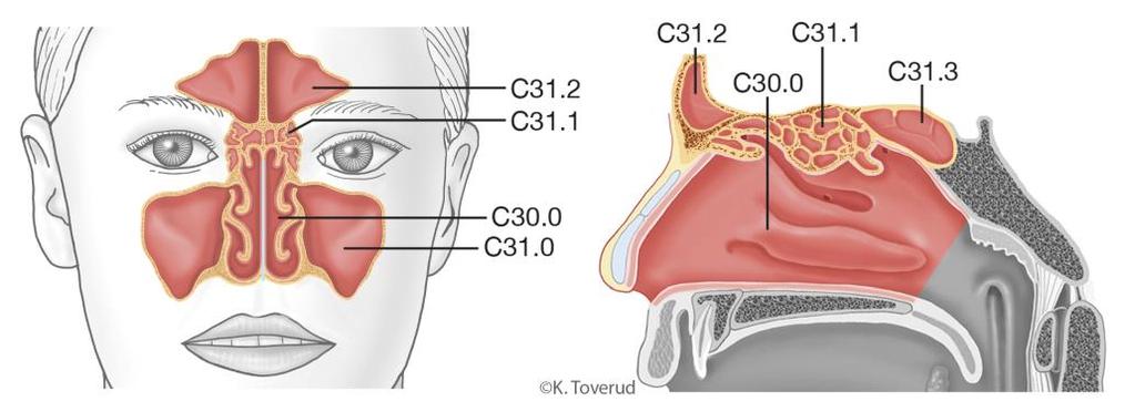 14.14 Näs- och bihålecancer 14.14.1 Översikt ICD-10 Näshåla 30.0 Maxillarsinus (käkhåla) C31.0 Etmoidalsinus (silbensceller) C31.1 Näsa-bihåla övergripande växt C31.
