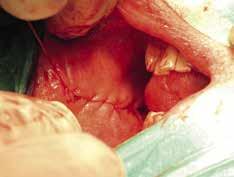 Perinealt snitt där en bulbär striktur har resecerats och är påväg att anstomoseras. suprapubiskateter och patienten blir lidande.