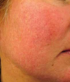 FAKTA 1. Exempel på försämrande faktorer Sol, värme, köld, temperaturväxling, blåst Alkohol Heta drycker, starkt kryddad mat Stress Kortisonpreparat Figur 1. Rosacea subtyp I.