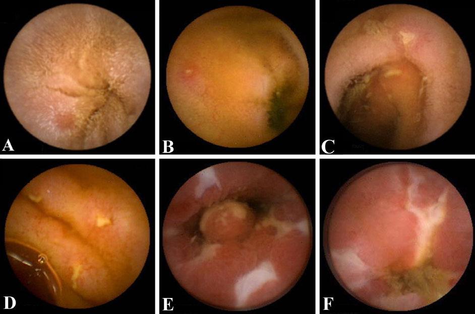 Fördelen med MR-enterografi är att den kan utföras på patienter med strikturer och att den dessutom påvisar transmural inflammation med komplikationer.