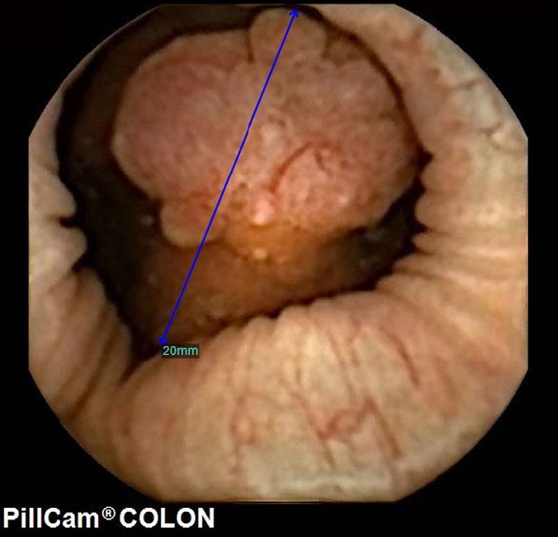 Figur 10. Kapselkoloskopisk bild visar en 20-mm stor polyp i kolon. Polypens storlek är bestämd med hjälp av en inbyggd programvara.