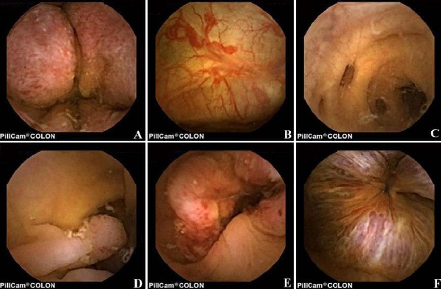 Kolonkapselendoskopi kan detektera vanliga patologiska fynd som inflammation, polyper, tumörer, divertiklar inte bara i kolon (Figur 11) utan den distala delen av