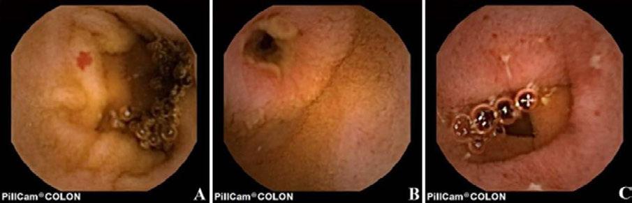 Figur 12. Kapselkoloskopifynd i tunntarmen. A= angioektasi, B= ulcererad striktur, C= Crohn-lesioner i ileum.