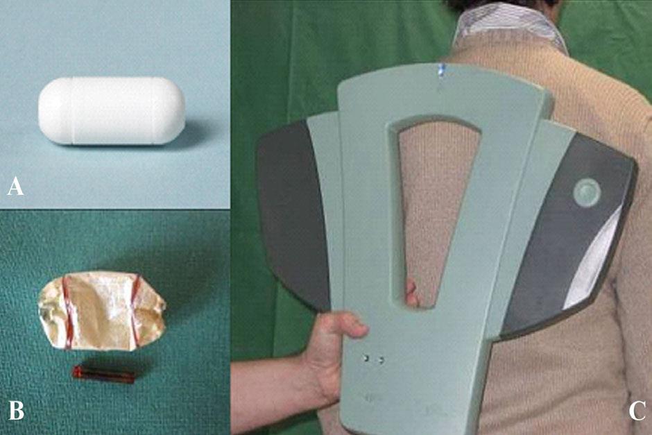 Figur 5. Testkapsel-undersökning kan utesluta passagehinder i mag-tarmkanalen inför videokapselenteroskopi.