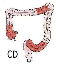 Crohns sjukdom Inflammation som resulterar i djupa sår genom tarmen.