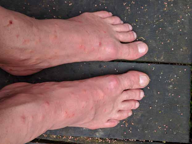 Fallbeskrivning Feber efter vistelse på Borneo Vi beskriver en 52-årig man, hobbyfotograf med ett brinnande intresse för att fånga djur med kameran.