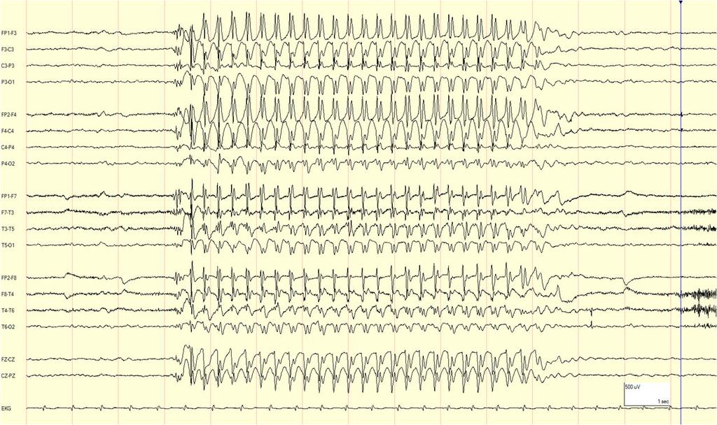 https://www.epilepsydiagnosis.org/syndrome/cae-eeg.html Körkortshinder vid ep-anfall 5 Innehav Grupp I kan ändå medges i följande fall 1.