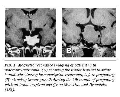 Prolaktinom och graviditet Hypofysen kan öka mer än 100% i storlek under graviditet