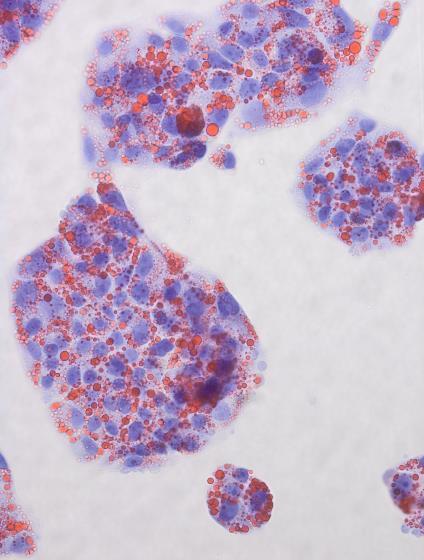 Sprint Bioscience är verksamma inom terapiområdet cancer av ett flertal anledningar; det är ett område med stort medicinskt behov och det område med störst försäljning av läkemedel globalt sett.