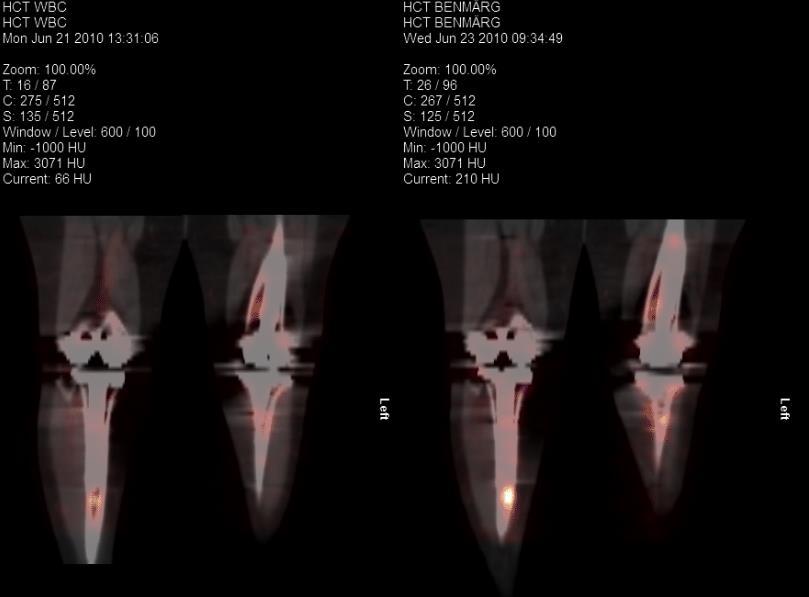 SPECT /CT 99m