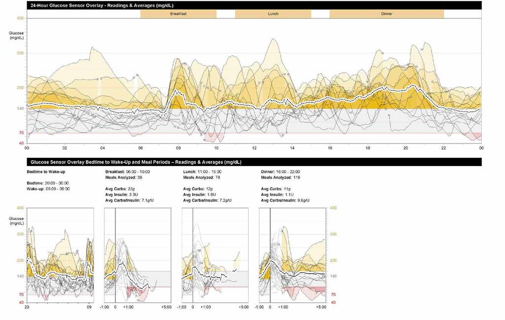 . CARELINK RAPPORTER SENSOR- OCH MÄTARÖVERSIKT ( AV ) Sensor och mätaröversiktsrapporten presenterar data från din pump, blodsockermätare, och sensor (CGM). Rapport av fokuserar på sensordata.