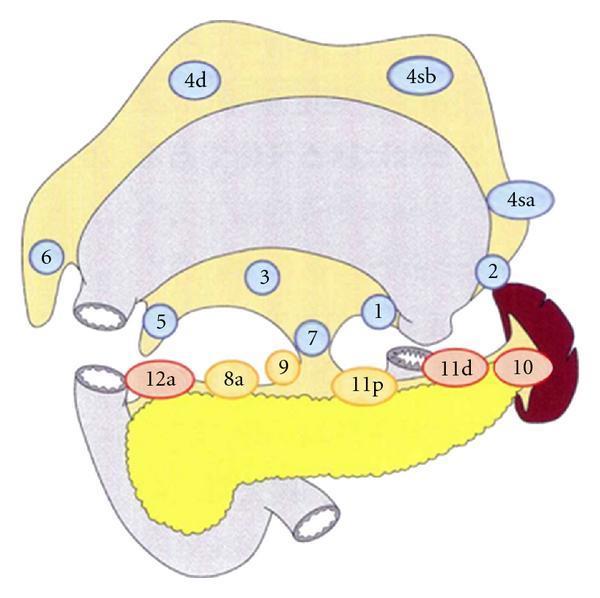 Figur 5. Distal ventrikelresektion. Distal ventrikelresektion: D1: 1, 3, 4, 5, 6, 7 (blå) D1+: 1, 3, 4, 5, 6, 7, 8, 9 (blå och gul) D2: 1, 3, 4, 5, 6, 7, 8, 9, 11, 12a (blå, gul, röd) Figur 6.