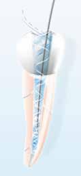 fungerar bra Patientvänlig Can be used with all solutions Passar till Suitable alla typer av forspolkanyler use with all needles Kompatibel med Compatible with all alla endodonti-kanyler endodontic