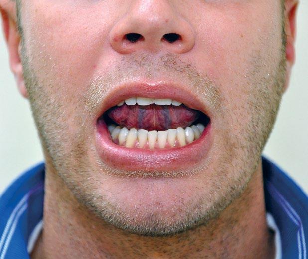 Avslappning... Låt underkäken slappna av, det vill säga tappa hakan genom att tona på M-ljudet. Underkäkens tänder bör vara på ett avstånd av 2-3 millimeter från överkäkens tänder.