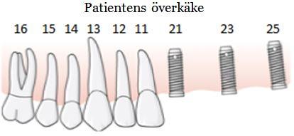 143 (191) Två åtgärd 425, en per käke, är ersättningsberättigande eftersom villkoret: att fyra eller fler implantat per käke opereras in är uppfyllt.