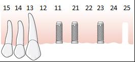 156 (191) 6.7.7.5.1 Exempel, långtidstemporär bro utförs på grund av osäker prognos för implantat, åtgärd 856 och 857 En patient med restbett 16 13 i överkäken har fått fyra implantat installerade i