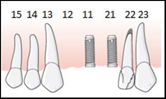 158 (191) utan suprakonstruktion i helt tandlös käke, två-, tre-, fyra eller flertandslucka eller friändstandlöshet när utvärdering eller belastning behövs innan permanent implantatkonstruktion kan