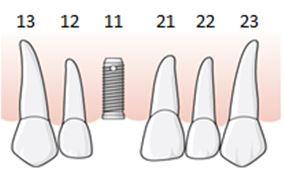 166 (191) Enligt villkoren för tillstånd 5448 ska det tillämpas för implantat som inte installerats under pågående ersättningsperiod och det inte finns någon permanent suprakonstruktion.