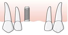 När de tre implantatkronorna lämnas ut rapporterar tandläkaren åtgärd 852 x 3 för implantatkronorna. 6.