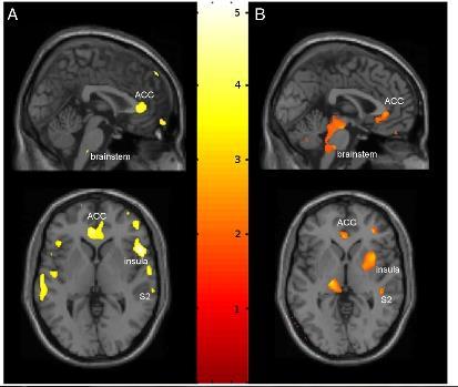 Kronisk smärta orsaken till minskad grå hjärnsubstans 32 patienter med kronisk smärta pga coxartros Decrease in grey matter in anterior cingulate cortex (ACC), right insular cortex, operculum,