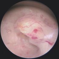 JONAS GUNNARSSON Bild 8. En liten bredbasig polyp i fundus. veckad slemhinna, lokaliserad hyperplasi eller en polypöst växande endometriecancer kan misstolkas som en enkel polyp.