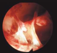 ARNE RÅDESTAD OCH JÖRGEN NATHORST-BÖÖS Bild 14. Synekier i uterus efter skrapning. visar att detta är effektivt. En återställd normal mens är ett gott tecken på att operationen lyckats.