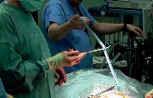 Varför använda Dopplex intraoperativa prober?