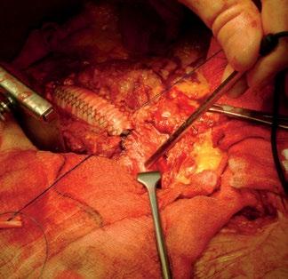 Kosmetisk kirurgi Hudtransplantation Pre Peri Post Lambåer baserade på perforatorartärer börjar bli väldigt populära Genom att använda den intraoperativa doppler-proben för att kontrollera