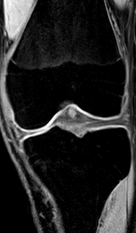 Femur Tillväxtzon Tibia Fig 2.