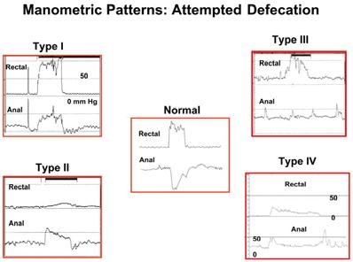 2014 Anorektal manometri