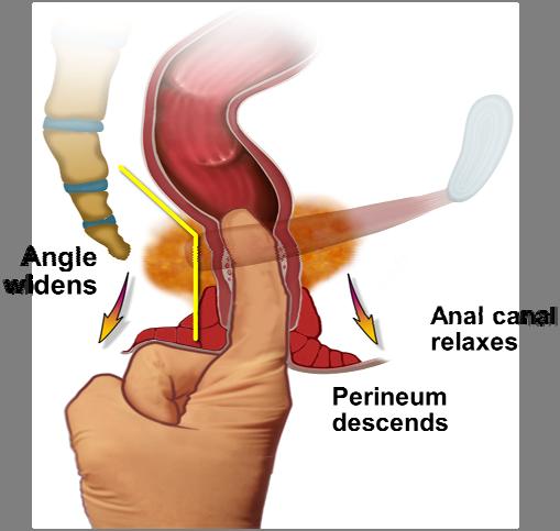 puborectalis Be patienten knipa