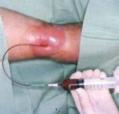 Akut inflammation Snabb