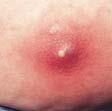 Akut inflammation Granulocytdominerad inflammation Exempel: bakterieinfektioner och vävnadsdöd (trauma).