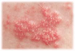 inflammatorisk reaktion (ex.