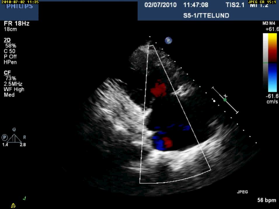 Tricuspidalisinsufficiens