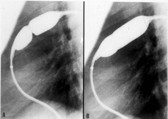 Ballongdilatation