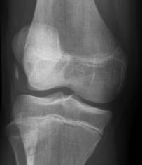 Patella luxation osteochondral