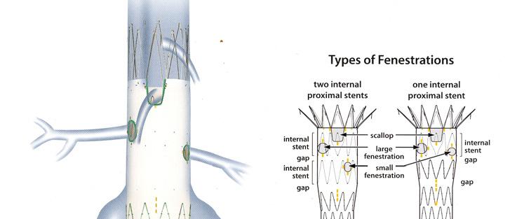 Aktuell teknologi 3a. Namn, beteckning för aktuell teknologi som detta HTA-projekt avser. Fenestrerade och branchade stentgraft för aortaaneurysm. (FEVAR= fenestrated endovascular aortic repair) 3b.